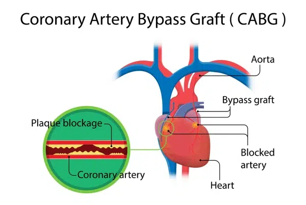Heart Bypass Surgery in India via VNR Medical Service