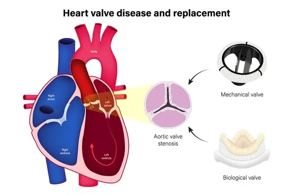 Heart Valve Surgery in India via VNR Medical Service